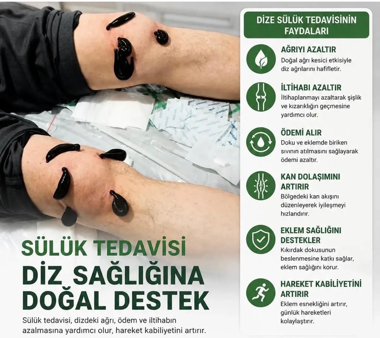 Sülük Tedavisi